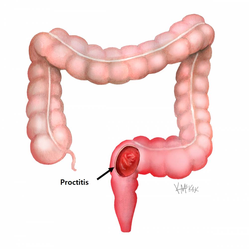 ilustrasi proktitis (colorectalsurgeonssydney.com.au)