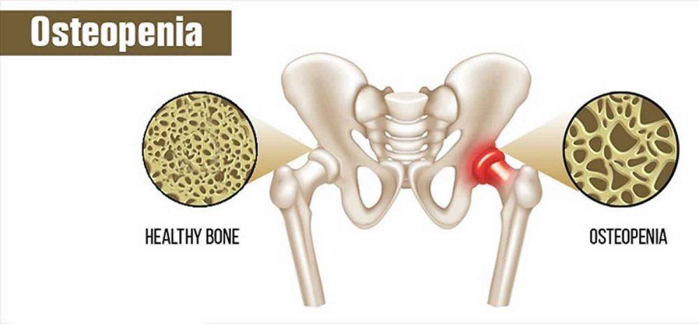 ilustrasi tulang yang mengalami osteopenia (healthjade.net)