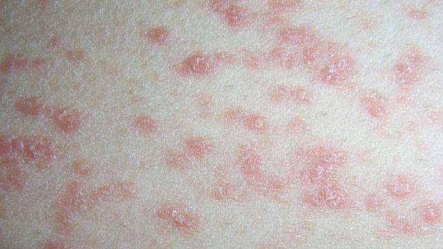 ilustrasi psoriasis gutata (healthline.com)