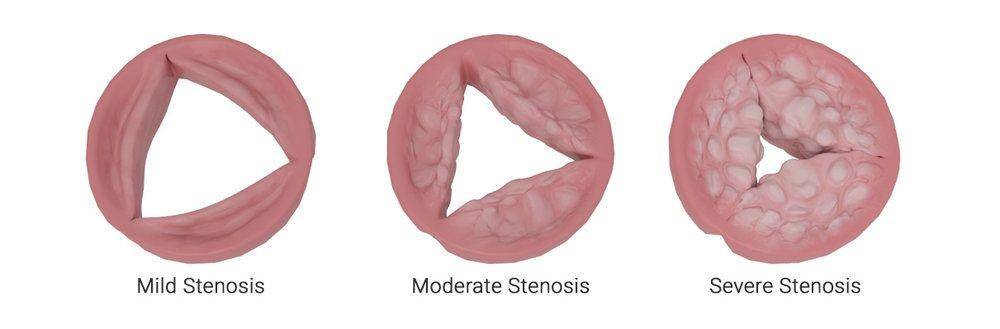 ilustrasi tingkat keparahan stenosis aorta (myval.com)