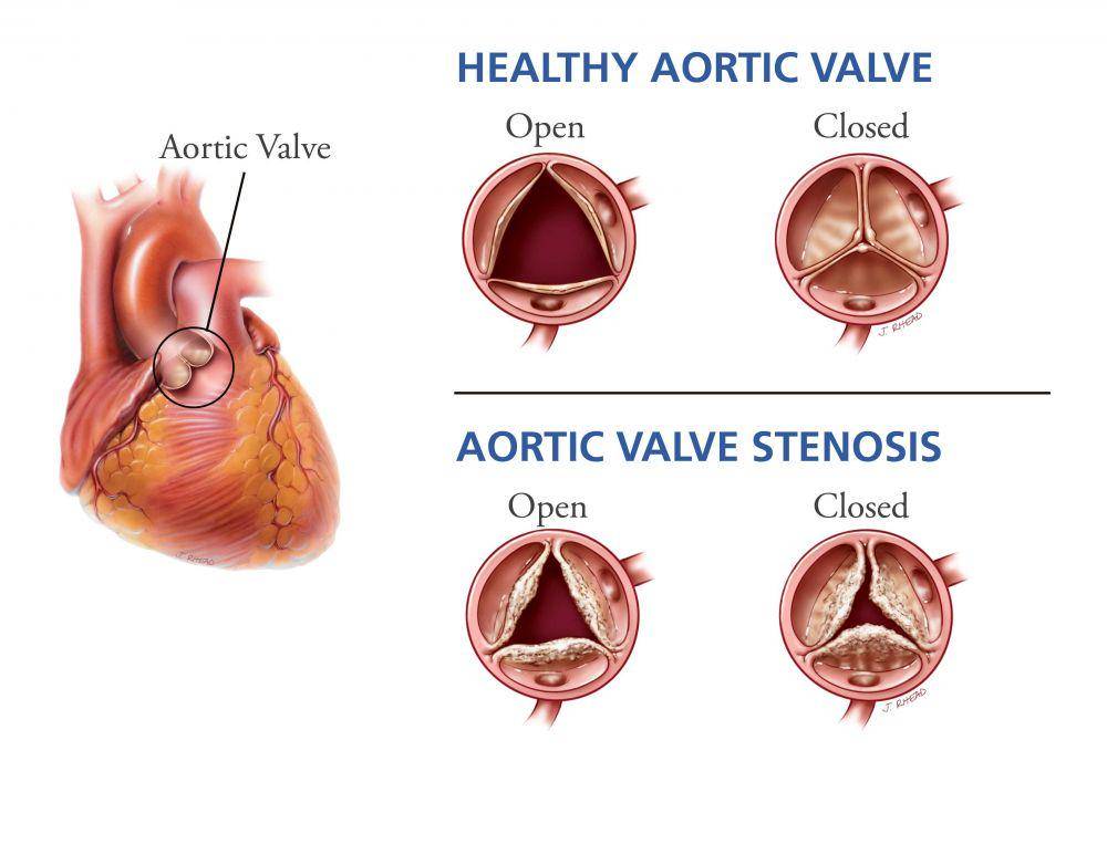 ilustrasi stenosis aorta (intermountainhealthcare.org)