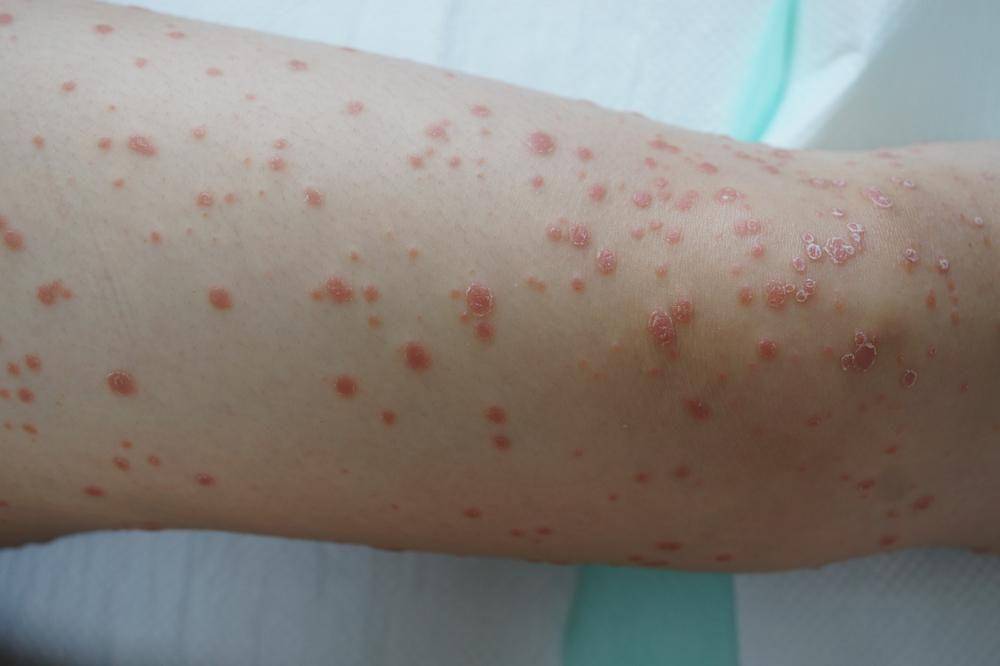 ilustrasi psoriasis gutata (prosoria.com)