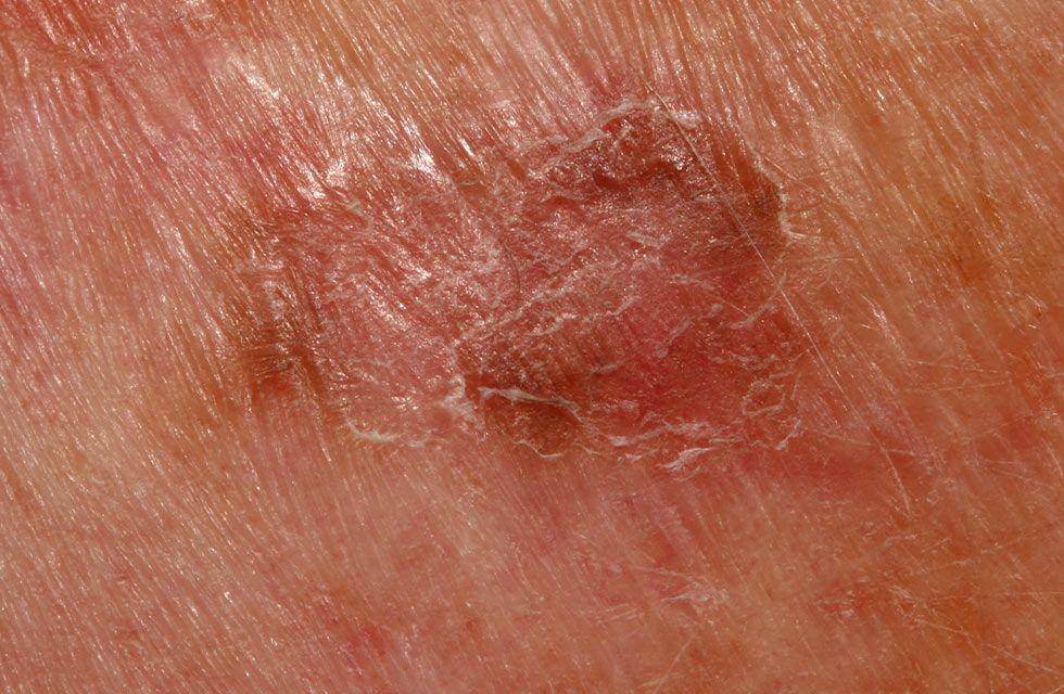 Lesi di kulit pada pasien dengan penyakit Bowen. (ballaratskincancer.com.au)