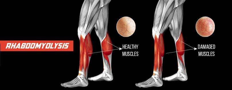 ilustrasi rhabdomyolisis (singaporesportsclinic.com)