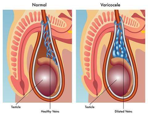 ilustrasi varikokel (stgeorgeurology.com.au)
