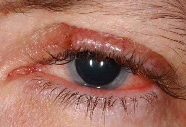 Karsinoma Sebasea: Penyebab, Gejala, Diagnosis, dan Pengobatan