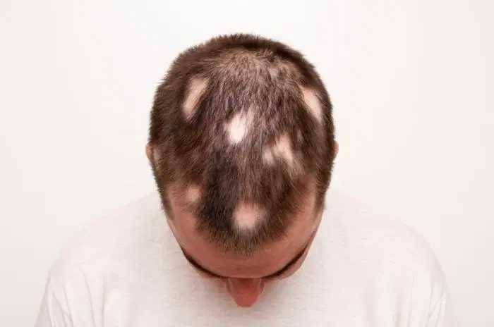 ilustrasi alopecia areata (medicalnewstoday.com)