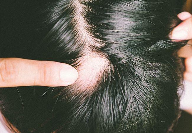 Alopecia Areata: Gejala, Jenis, Penyebab, dan Pengobatan