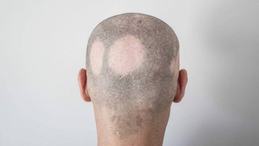 ilustrasi alopecia areata (empr.com)