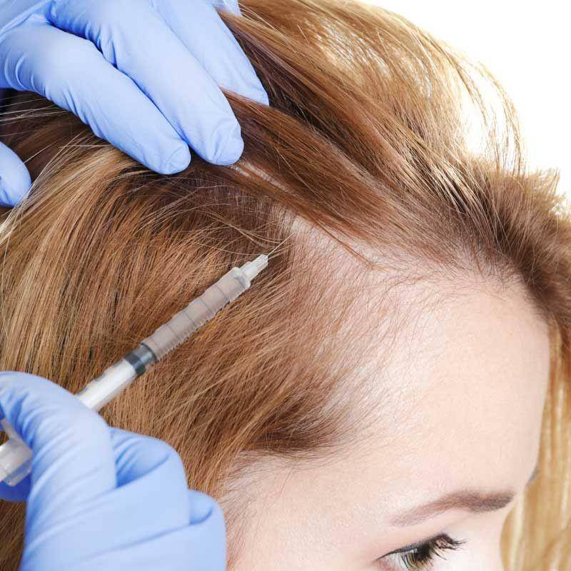 Terapi injeksi untuk alopecia areata. (philahomeopathy.com)