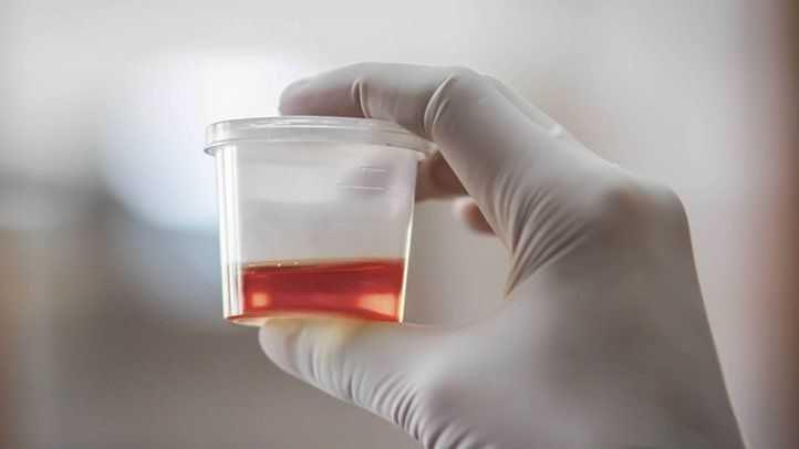 Kenali Hematuria, Bikin Urine Berwarna Merah seperti Darah atau Teh