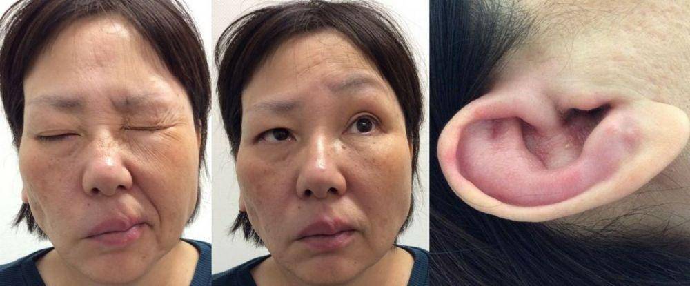 Pasien dengan sindrom Ramsay Hunt. (pmj.bmj.com/Kotaro Kunitomo)