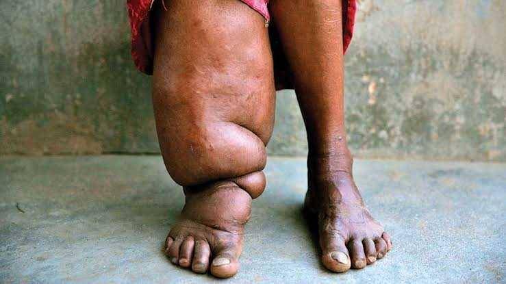 ilustrasi filariasis limfatik atau kaki gajah (pwmafrica.com)