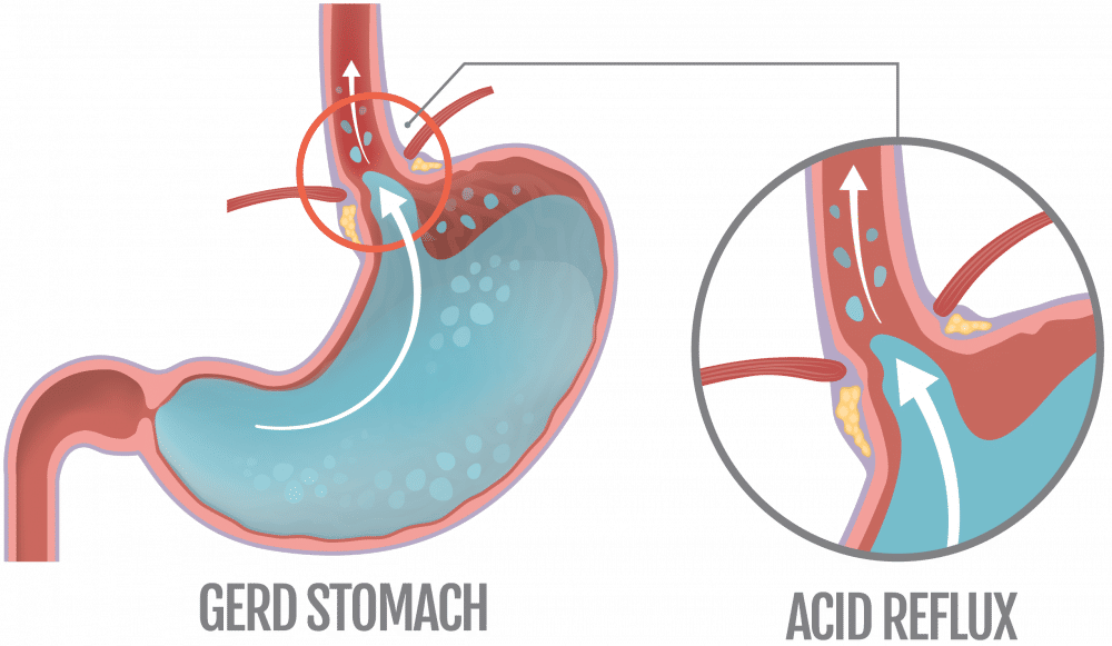 ilustrasi GERD (detoxorganics.com)