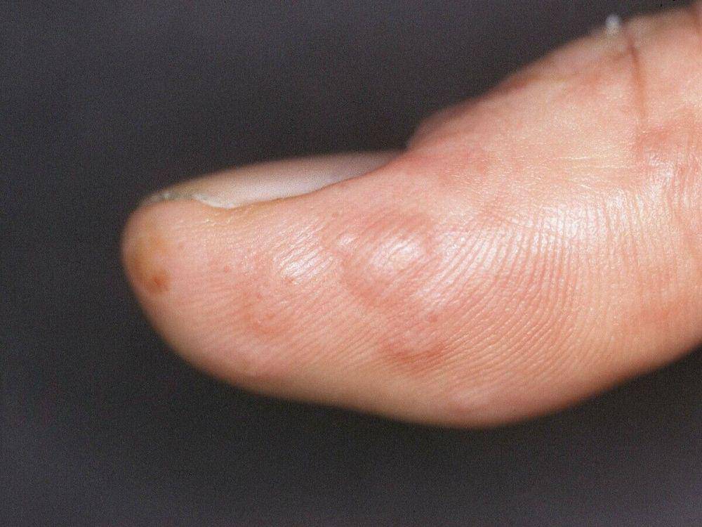 Pompholyx pada jari tangan (altmeyers.org)