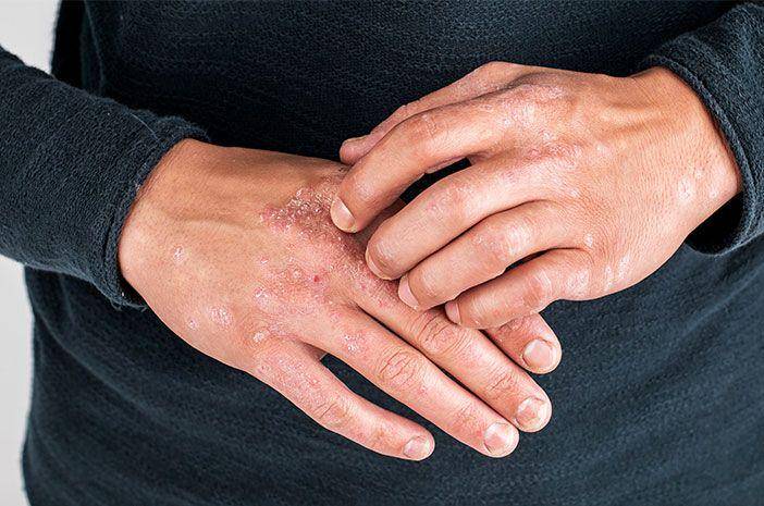 Popmpholyx pada tangan (halodoc.com)