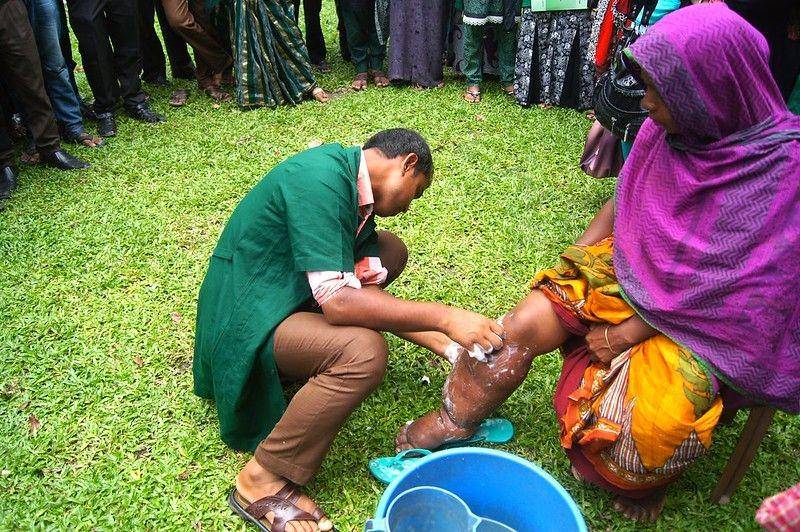 Pasien penyakit kaki gajah atau filariasis limfatik di Bangladesh (flickr.com/CDC Global)