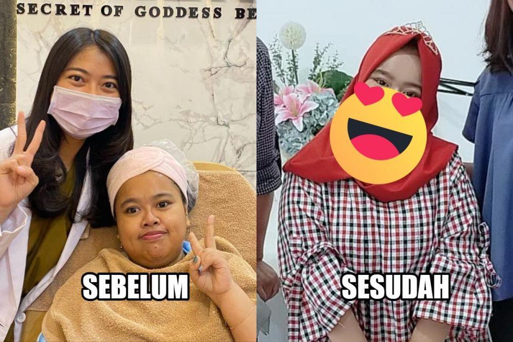 10 Potret Kekeyi Sebelum dan Sesudah Filler Hidung, Pangling Gak?