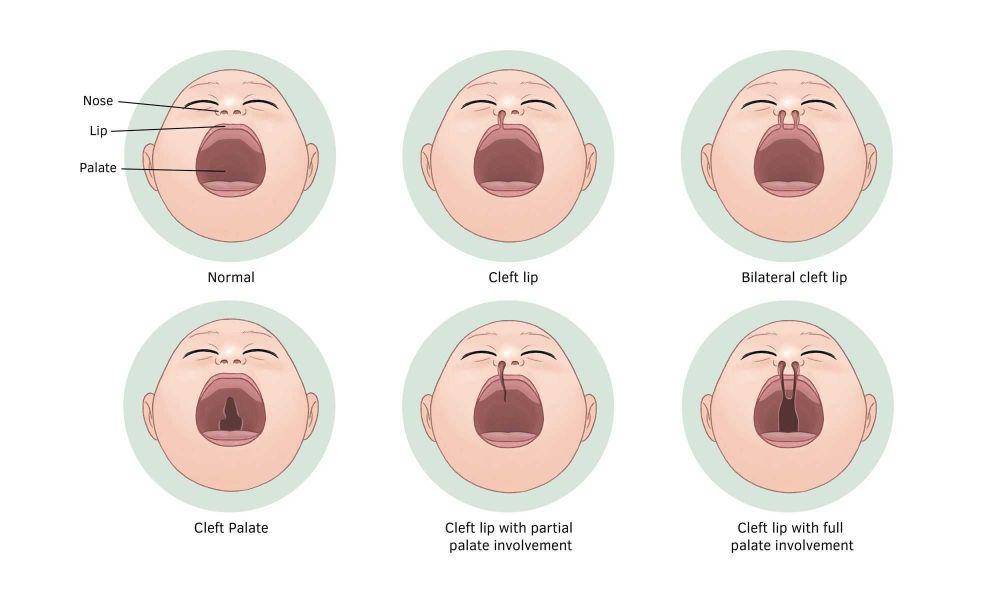 ilustrasi tipe sumbing dan celah (doctorsaustralia.com.au)