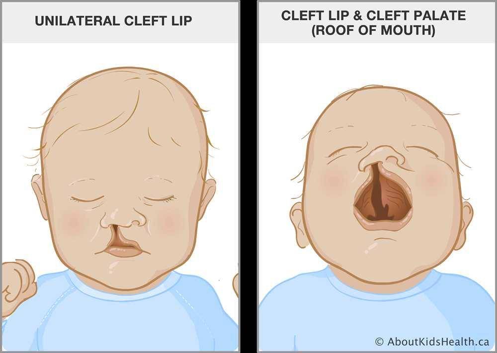 ilustrasi bibir sumbing dan celah langit(aboutkidshealth.ca)