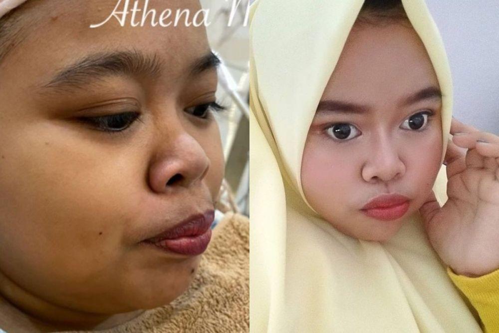 10 Penampilan Terbaru Kekeyi Setelah Filler Hidung, Ngaku Lebih PD
