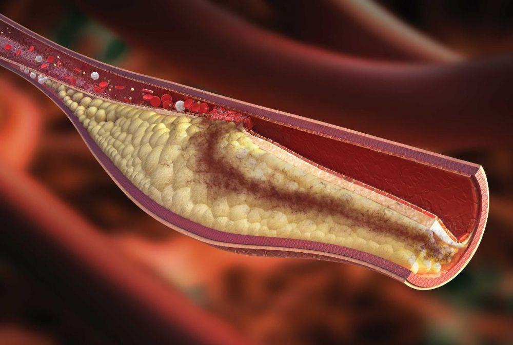 Bisa Menyebabkan Penyakit Jantung Koroner, Ini 5 Fakta Hiperlipidemia