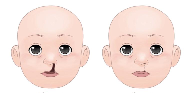 6 Fakta seputar 
Bibir Sumbing dan Celah pada Langit Mulut