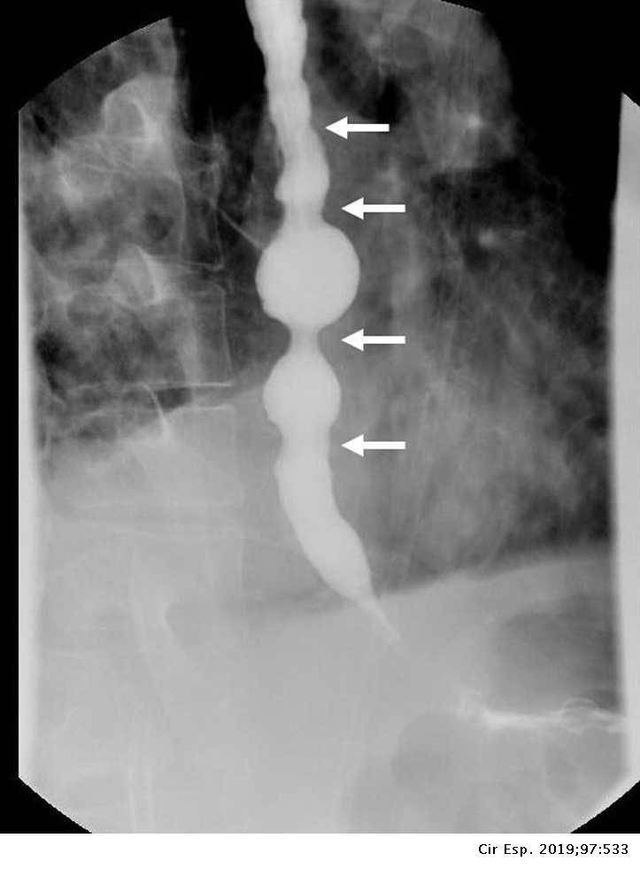 ilustrasi diffuse esophageal spasm (elsevier.es)