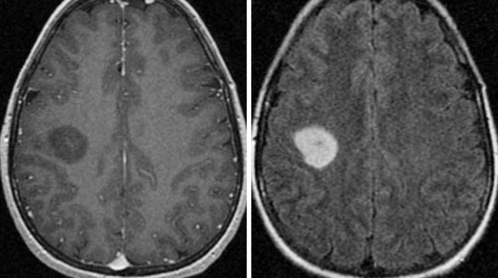 ilustrasi low-grade diffuse astrocytoma (neurosurgicalatlas.com)
