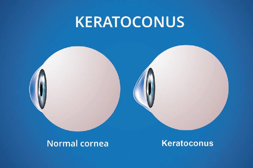 ilustrasi keratokonus (crstoday.com)