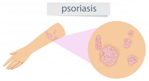 ilustrasi Psoriasis di lengan (freepik.com/brgfx)