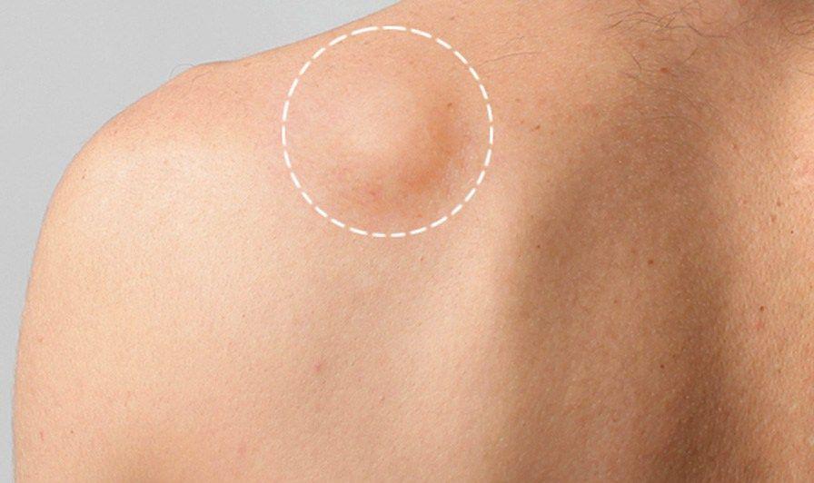Lipoma: Penyebab, Gejala, Pengobatan, dan Komplikasi