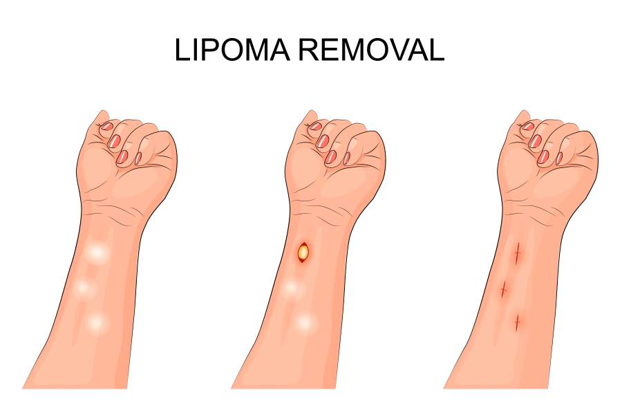 ilustrasi pengangkatan lipoma (cosmeticsureonoftampa.com)