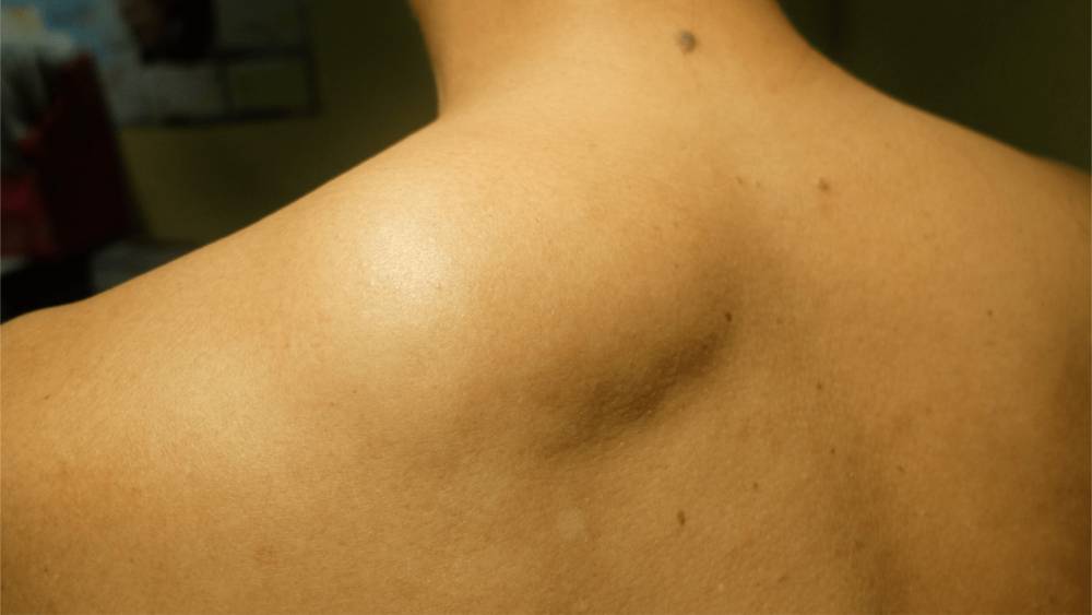 ilustrasi lipoma berukuran besar di punggung (excellencemedical.ie)