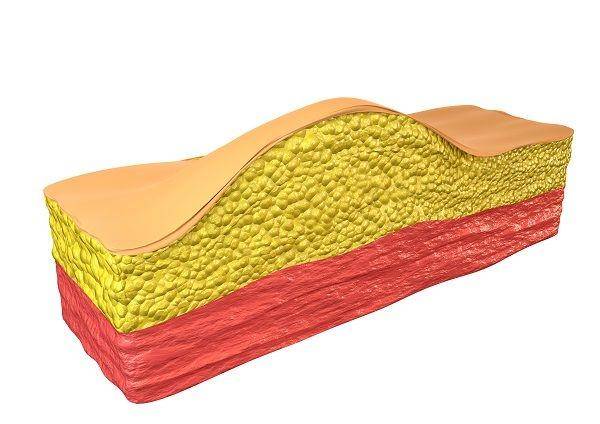 ilustrasi lipoma (claritysurgicalny.com)