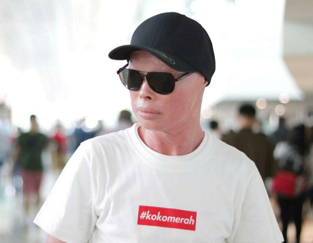 Mengenal Ichthyosis dan Cara Melawan Stigma Negatif ala Koko Merah