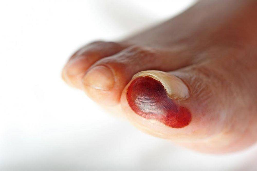 ilustrasi gangren pada jari kaki (medicalnewstoday.com)