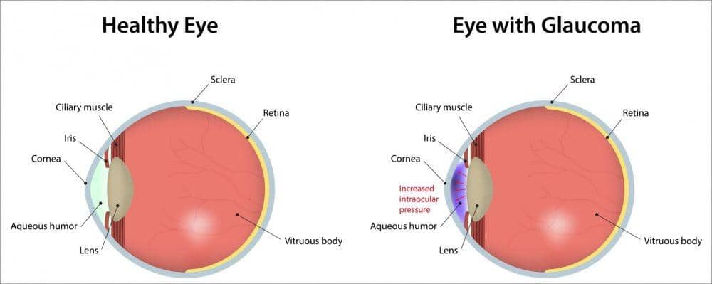 ilustrasi glaukoma (williamsoneyeinstitute.com)