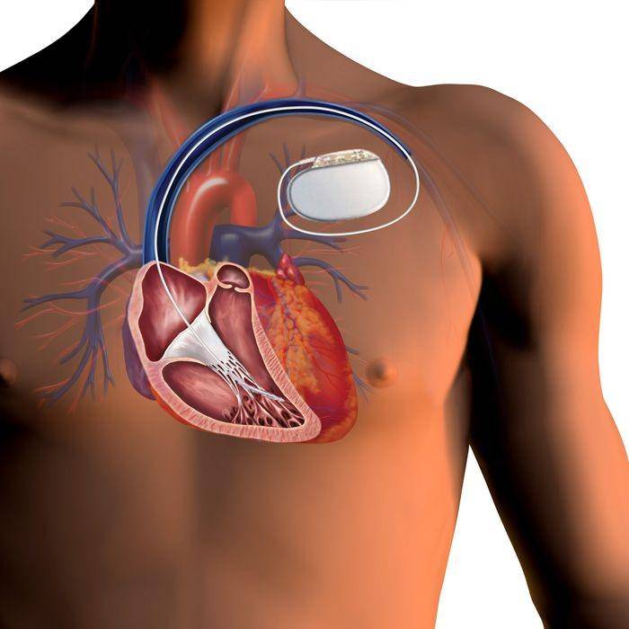 ilustrasi ICD di tubuh (washingtonhra.com)
