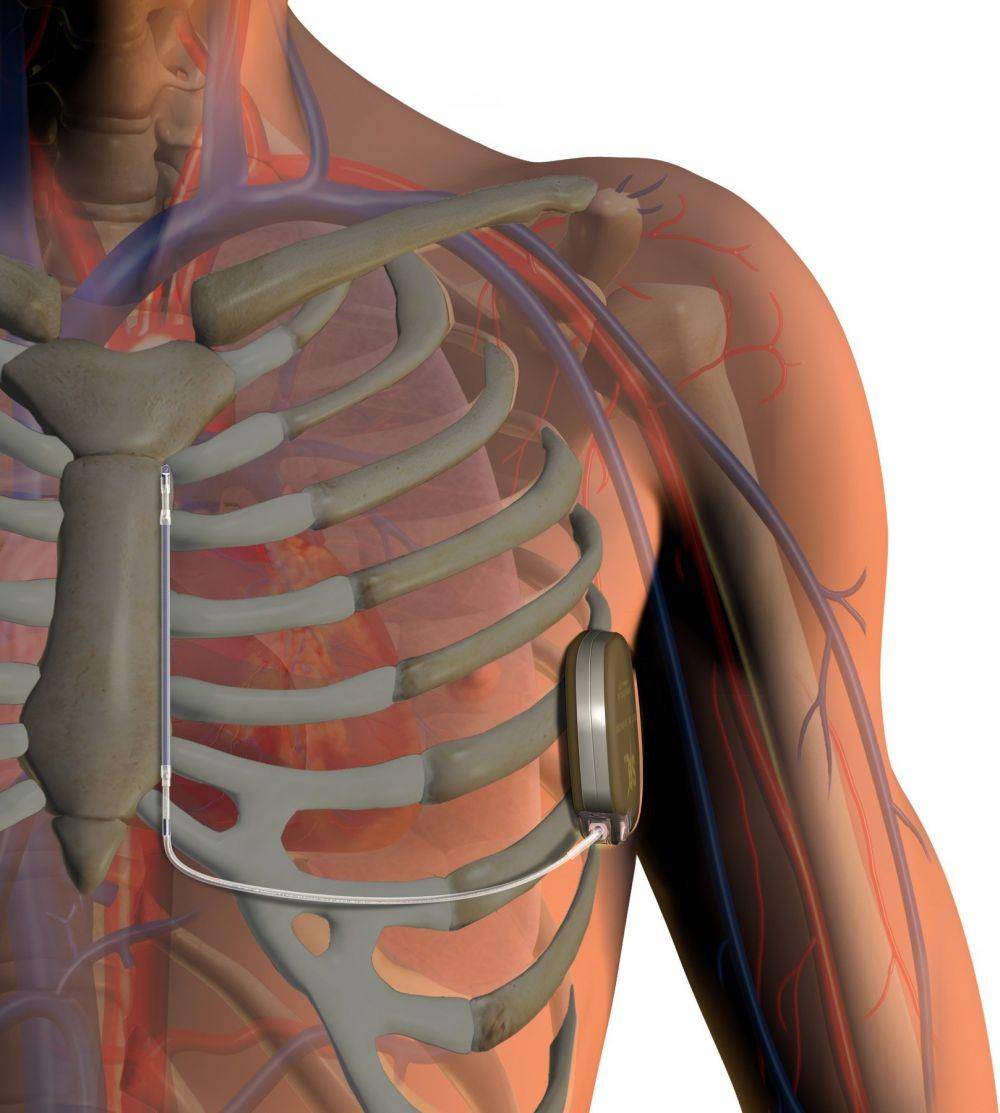 ilustrasi pemasangan S-ICD (dicardiology.com)