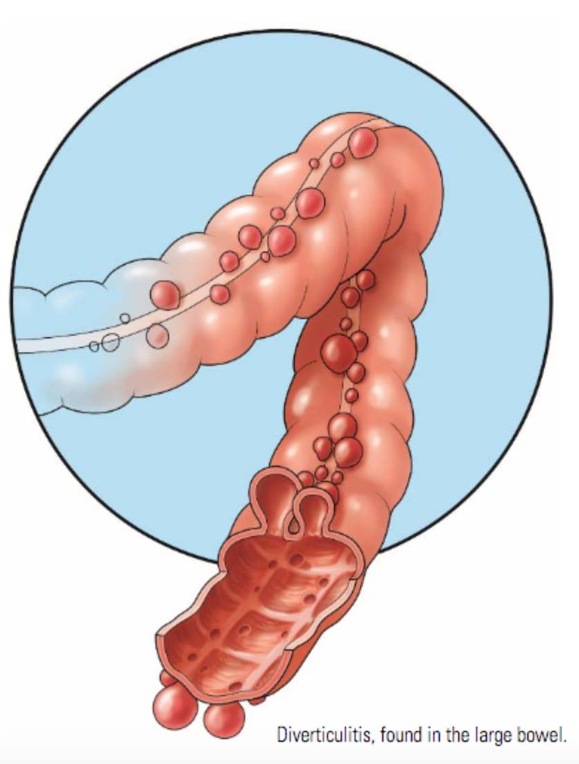 ilustrasi divertikulitis di usus besar (gastro.org)