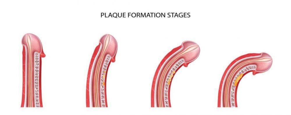 ilustrasi penyakit Peyronie (peyroniesdisease.co.uk)