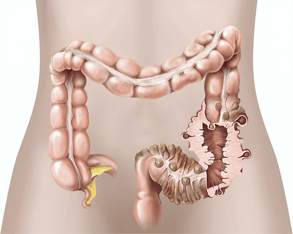 ilustrasi divertikulitis (healthdirect.gov.au)