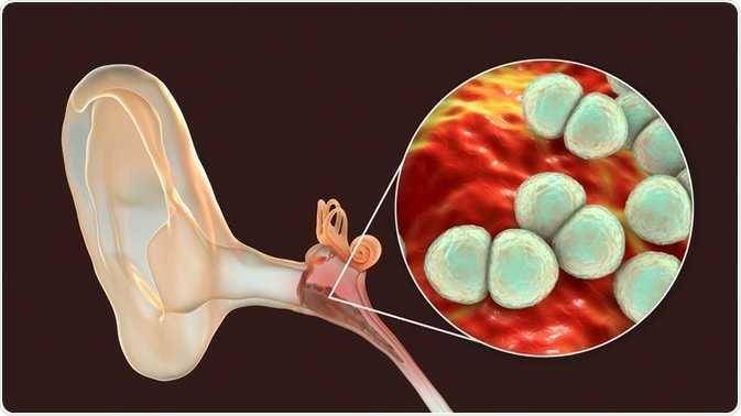 ilustrasi otitis media atau infeksi telinga tengah (news-medical.net)