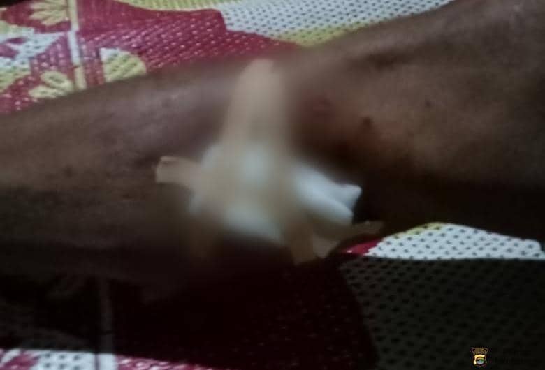 Luka diderita korban setelah menerima serangan buaya muara di sungai Semaka (IDN Times/Istimewa)