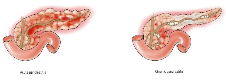 ilustrasi perbedaan antara pankreatitis akut dan pankreatitis kronis (gastro.org)