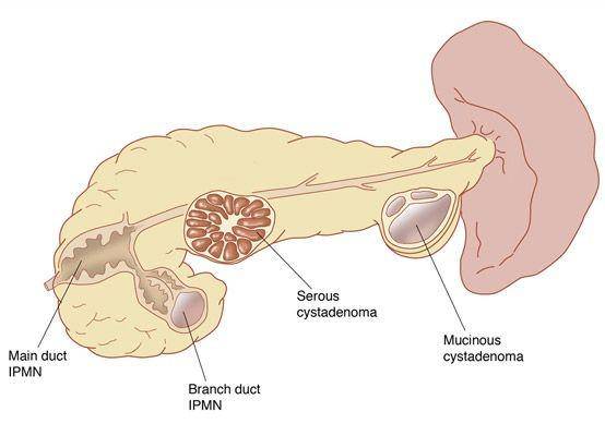 ilustrasi pseudokista atau pseudocyst di pankreas (stanfordhealthcare.org)