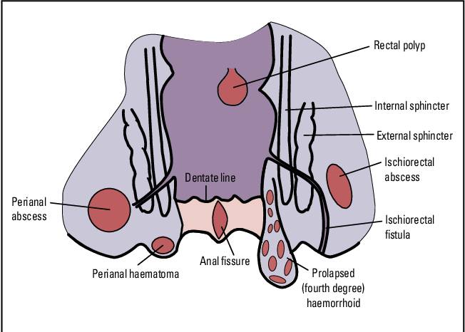 ilustrasi hematoma perianal (semanticscholar.org)