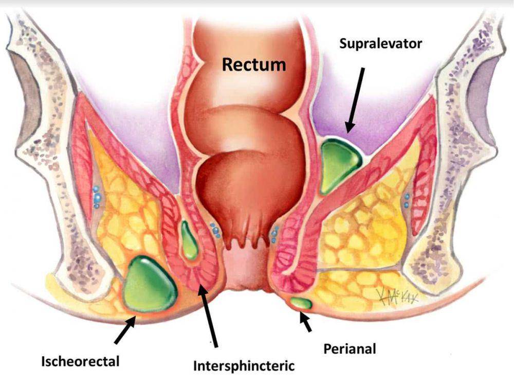 ilustrasi abses anus (colorectalsurgeonssydney.com.au)