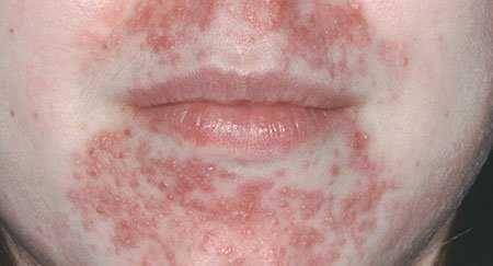 ilustrasi dermatitis perioral (strnotdrem.com)